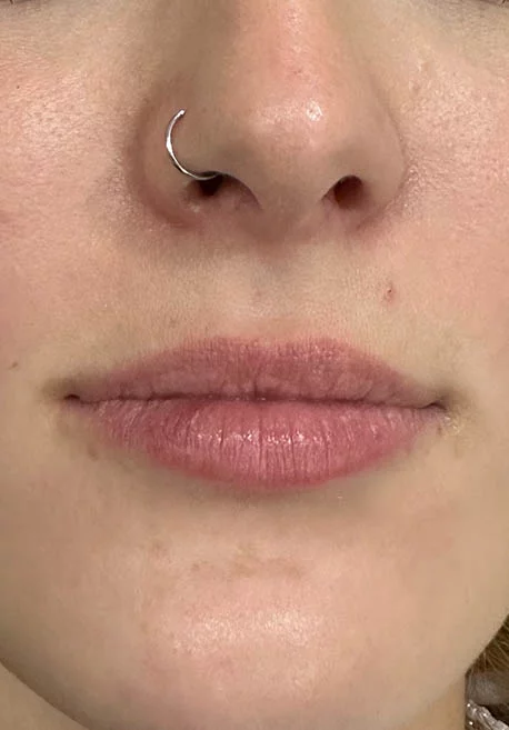 aumento de labios en Valladolid