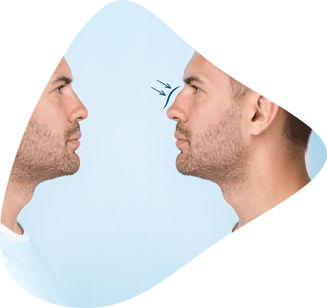 Rinomodelacion antes y despues