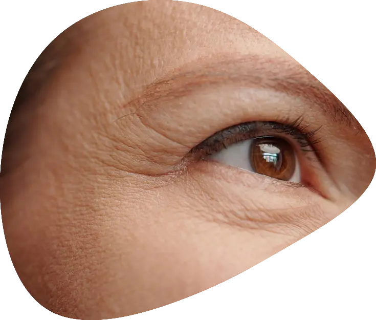 patas de gallo botox valladolid