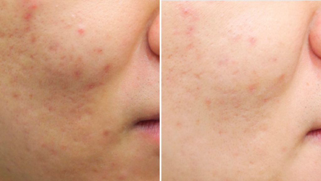 Antes y después del tratamiento de limpieza facial en Valladolid