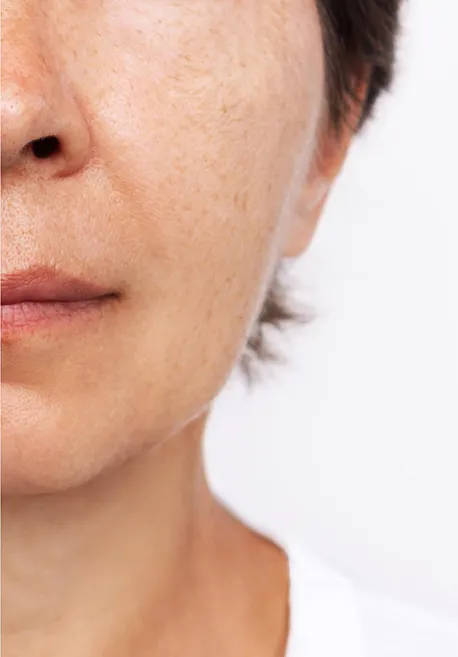 Después de láser facial en Valladolid para mejorar manchas, arrugas finas y textura de la piel