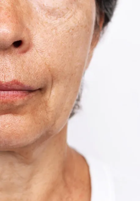 Antes de láser facial en Valladolid para mejorar manchas, arrugas finas y textura de la piel