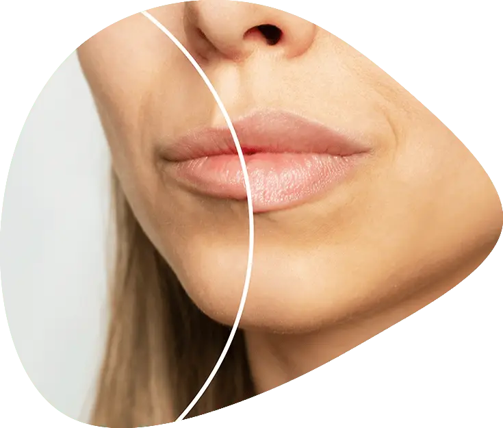aumento de labios con acido hialuronico
