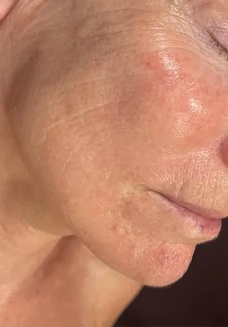 Antes y después de carboxiterapia facial en Valladolid