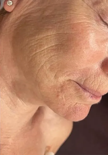 Antes y después de carboxiterapia facial en Valladolid para mejorar ojeras y firmeza