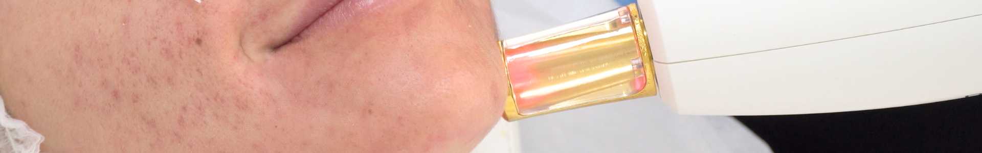 quitar manchas cara laser valladolid