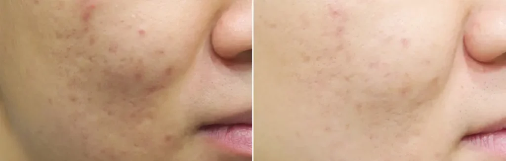 Antes y después del tratamiento Aquapure en AJ Clinic, mejora notable de la piel