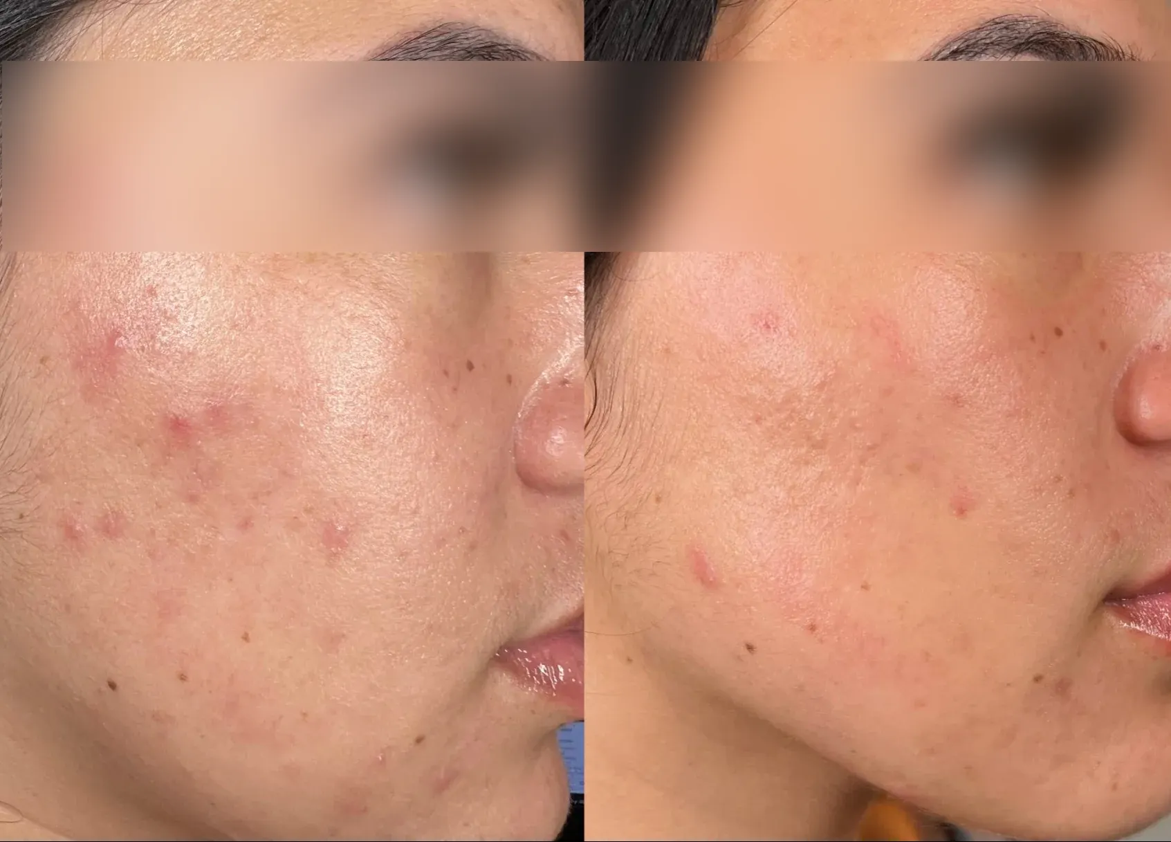 Antes y después del Hydrofacial en Valladolid con Aquapure, mejora de textura y luminosidad