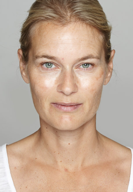 Antes y después de tratamiento de medicina estética en Burgos