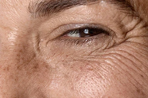 Tratamiento arrugas de expresión en clínica estética en Burgos