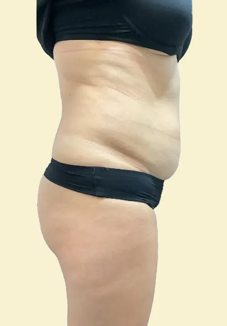 Antes de Endolift corporal en Valladolid flacidez abdominal y pérdida de firmeza en abdomen