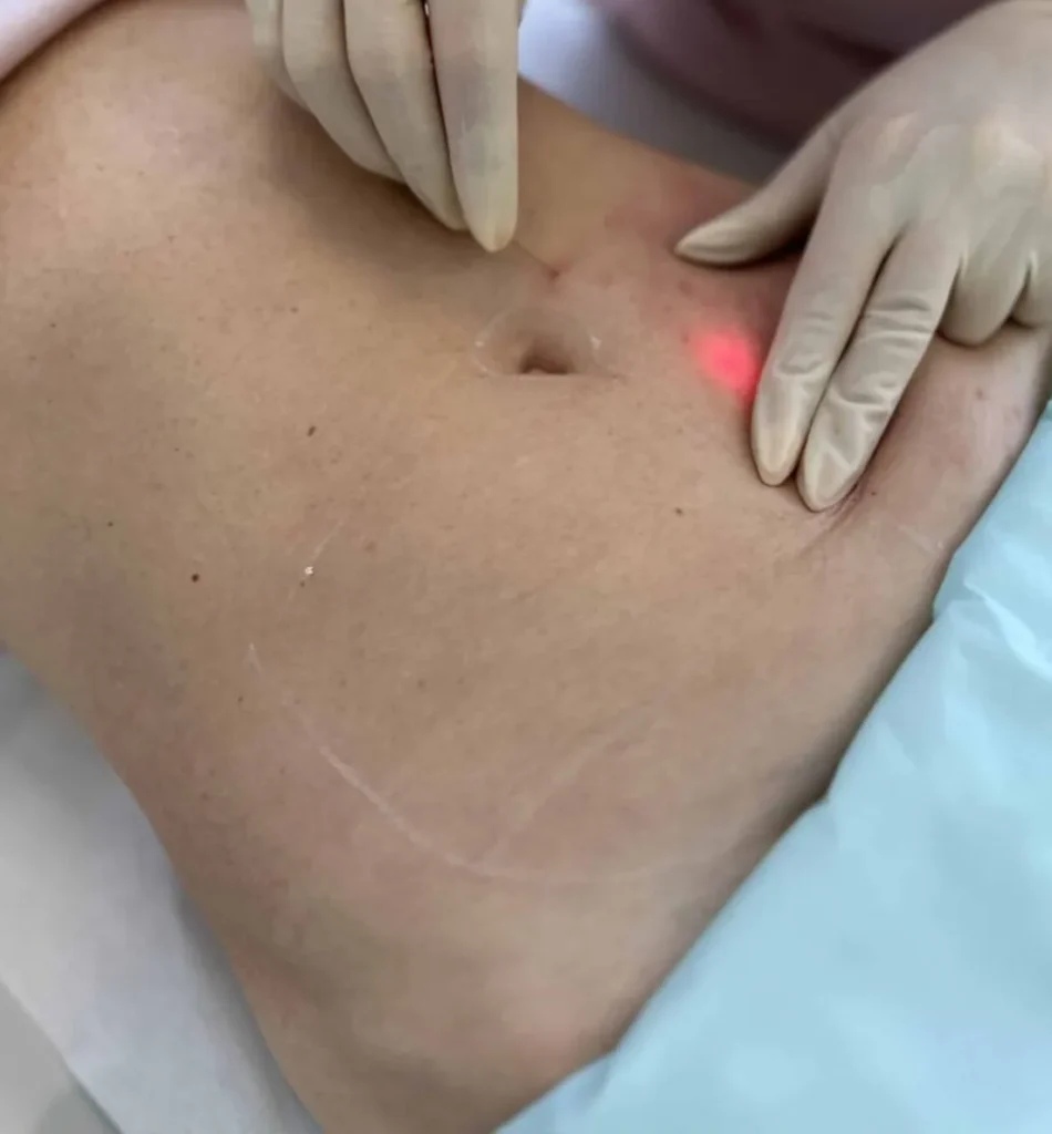 Endolift corporal en Valladolid para flacidez en abdomen brazos y muslos sin cirugía