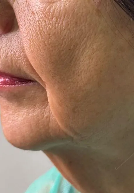 Antes de Endolift facial en Valladolid papada y flacidez en el óvalo facial y cuello