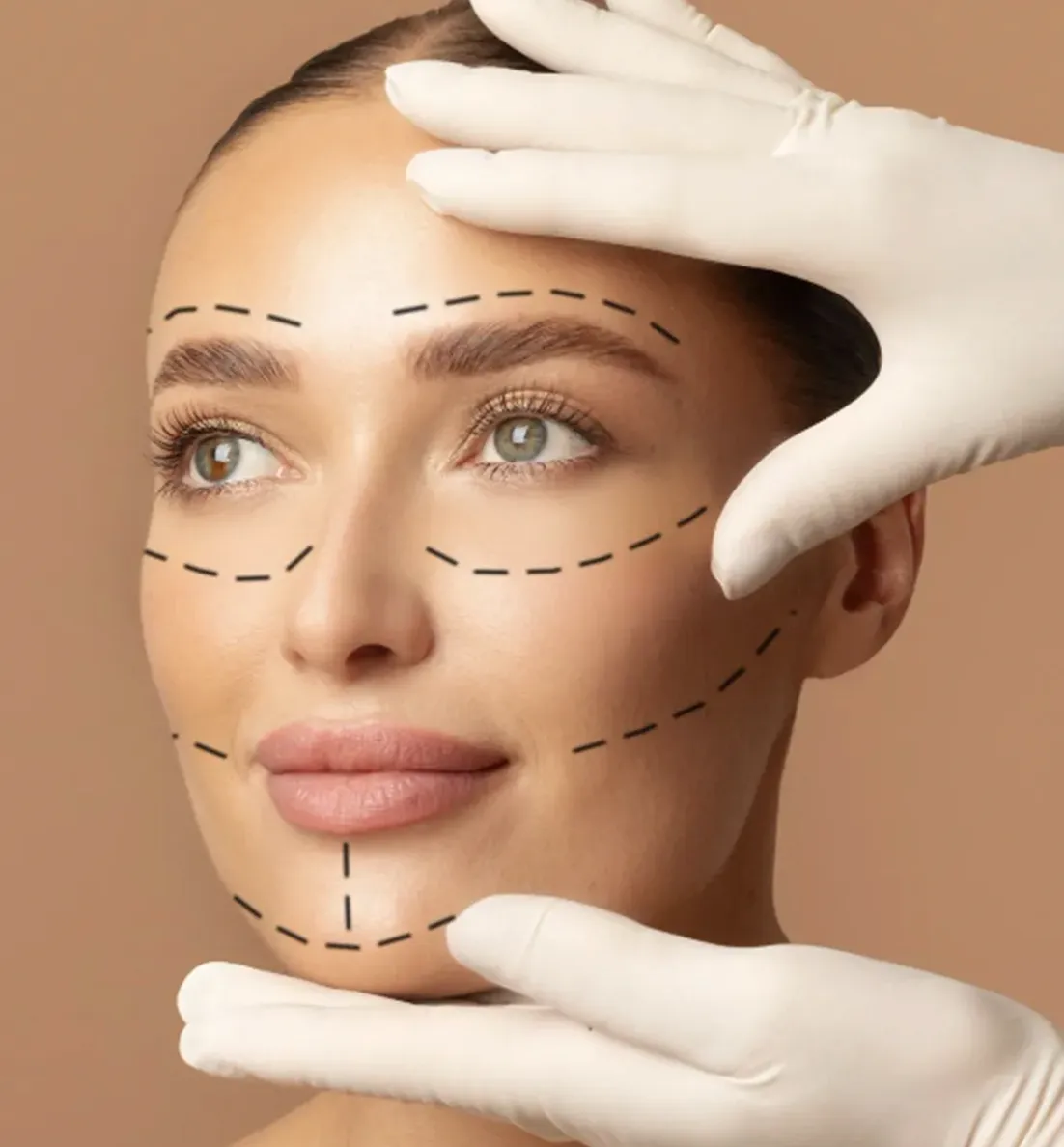 Endolift facial en Valladolid para flacidez facial papada y redefinición del óvalo sin cirugía