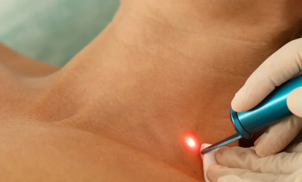 Endolift en Valladolid tratamiento facial y corporal sin cirugía con láser para flacidez y rejuvenecimiento