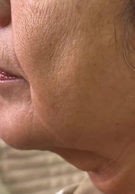 Resultados Endolift facial en Valladolid reducción de papada y mejora del contorno facial sin cirugía