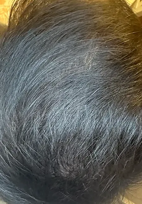 PRP capilar dutasteride antes y despues