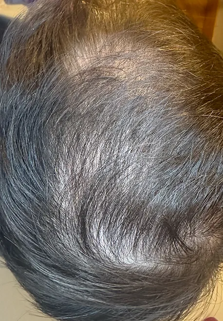 PRP capilar antes y despues