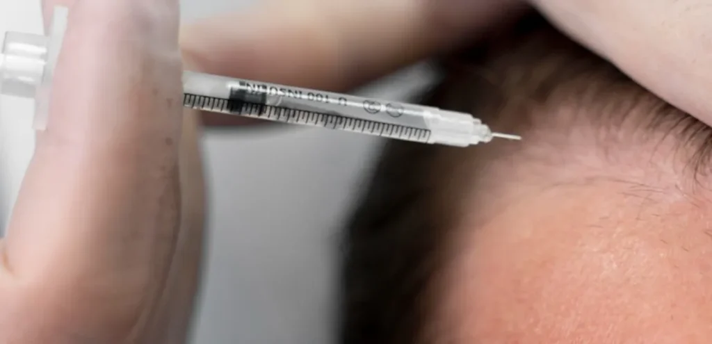 tratamiento de alopecia con PRP en Burgos infiltración capilar con plasma rico en plaquetas