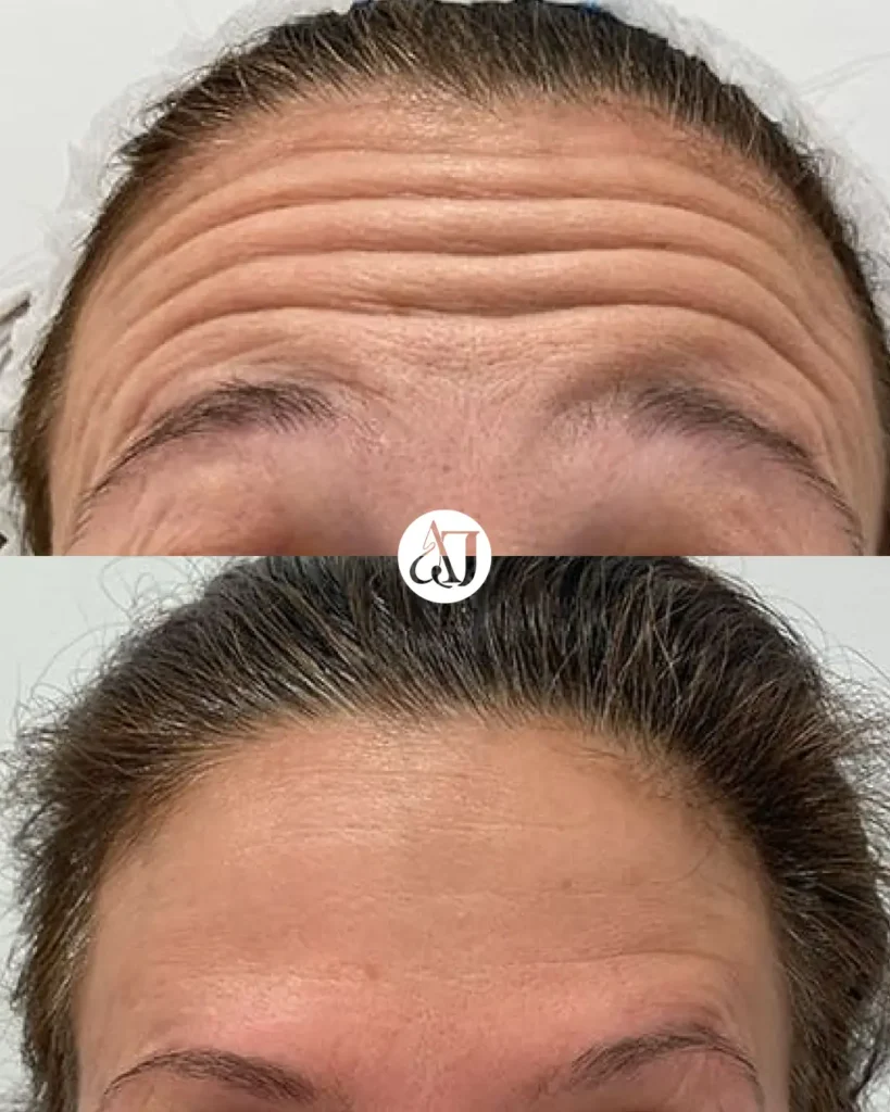 Antes y después de tratamiento con bótox para arrugas de expresión en Valladolid