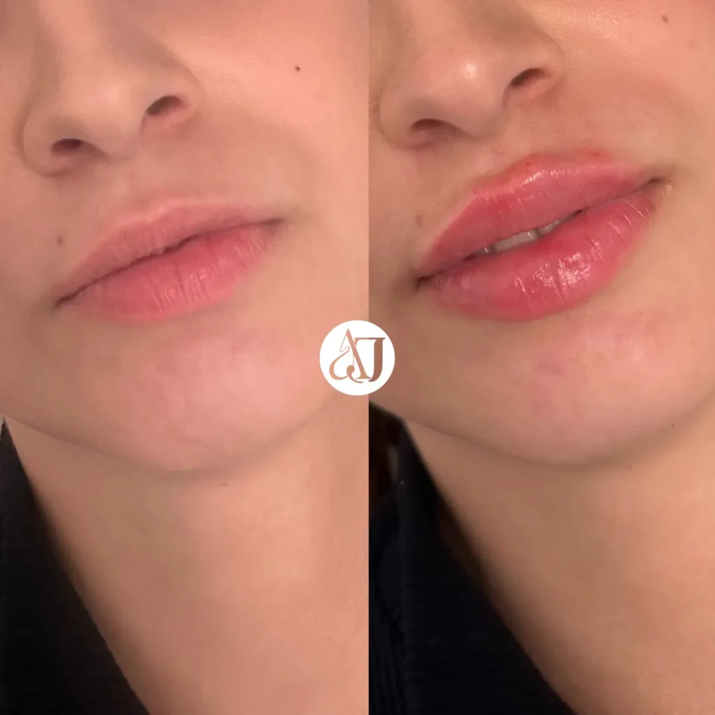 Antes y después de un aumento de labios con ácido hialurónico en Burgos realizado por la Dra. Andreina Jiménez