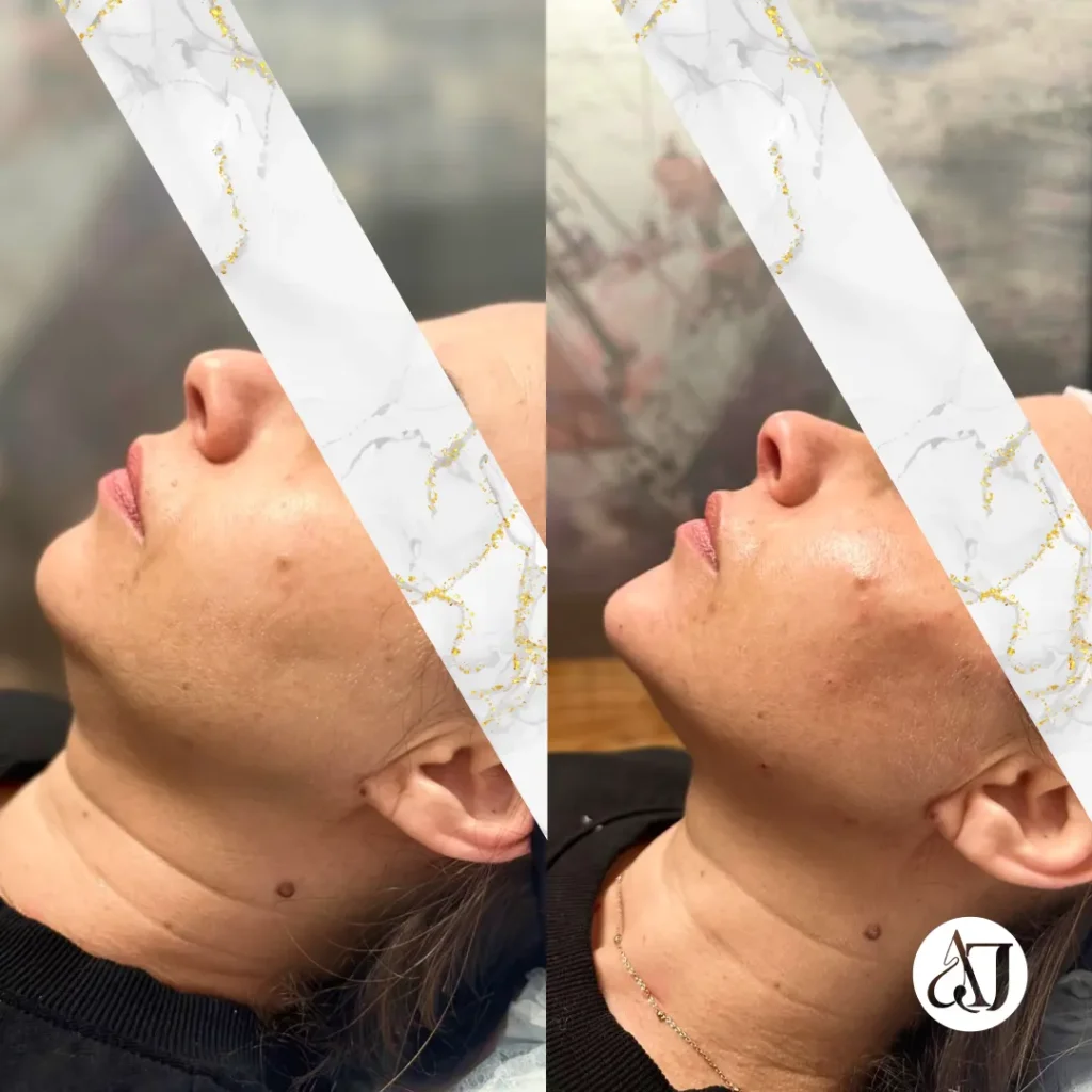 Antes y después de un tratamiento de aumento de mentón con ácido hialurónico en Burgos realizado por la Dra. Andreina Jiménez