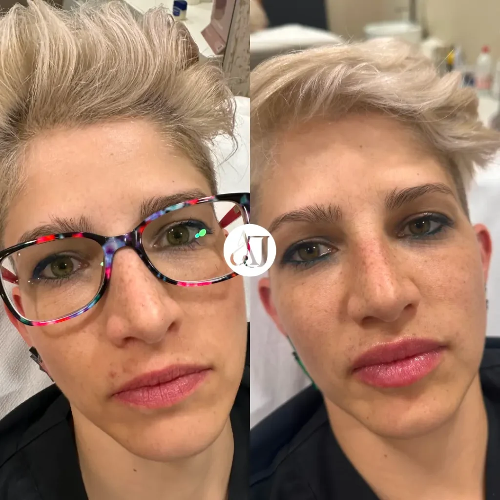 Antes y después de labios con ácido hialurónico
