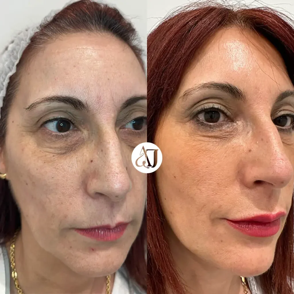 Antes y después de armonización facial Full Face con ácido hialurónico