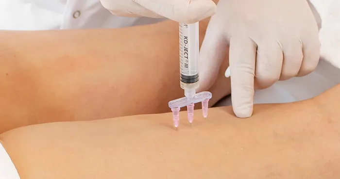 Aplicación de carboxiterapia corporal mediante pequeñas inyecciones de dióxido de carbono medicinal.