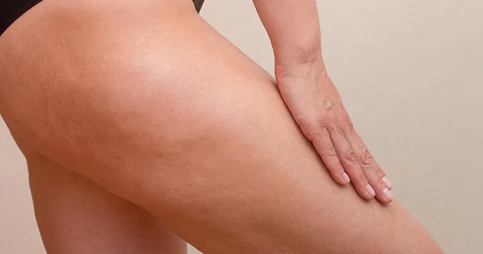 Tratamiento para celulitis y piel de naranja en Valladolid