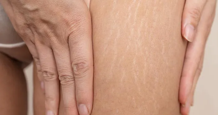 Tratamiento para Textura de piel con celulitis en el muslo, valorada en consulta de medicina estética.